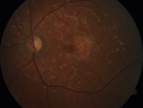 Stargardt's Macular Dystrophy
62 year old man with good vision
