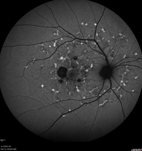 Stargardt's Macular Dystrophy
62 year old man with good vision
