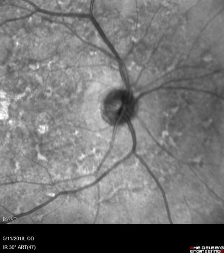 Stargardt's Macular Dystrophy
62 year old man with good vision
