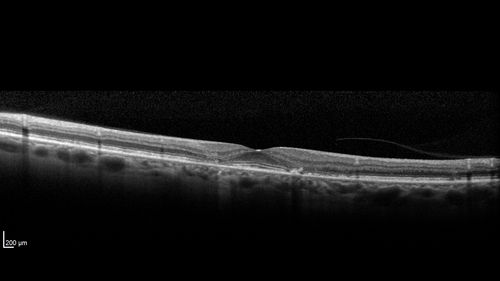 Stargardt's Macular Dystrophy
62 year old man with good vision
