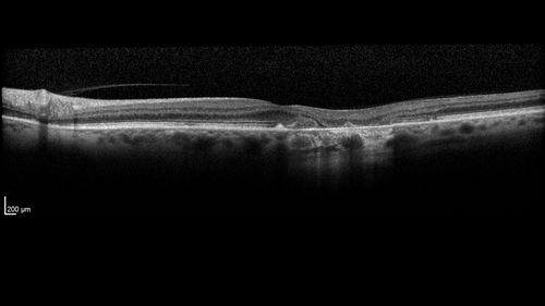 Stargardt's Macular Dystrophy
62 year old man with good vision
