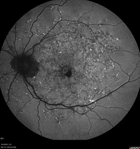 Stargardt's Macular Dystrophy ABCA4 positive
 Fundus Autofluorescence shows central atrophy with Hyper FAF pisciform triradiate lesions. Images show some progression over 3 years of macular dystrophy.
