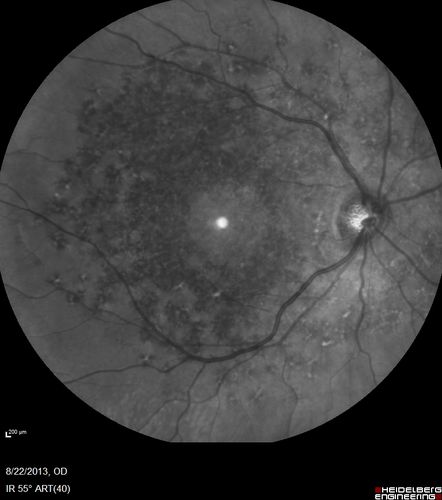 Stargardt's Macular Dystrophy ABCA4 positive
Images show some progression over 3 years of macular dystrophy.
