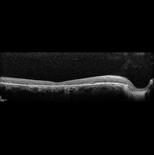 Stargardt's Macular Dystrophy ABCA4 positive
Images show some progression over 3 years of macular dystrophy.
