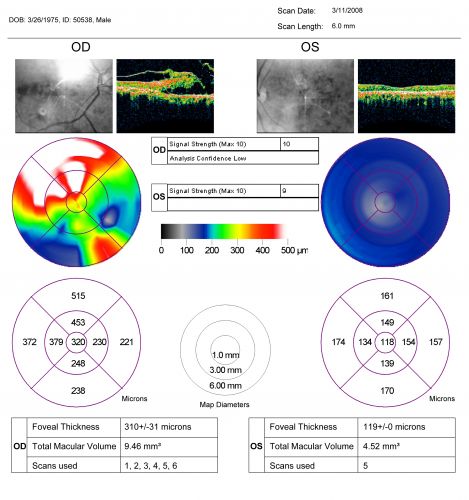 Stargart's Macular Dystrophy Severe - New Vitreomacular Asymptomatic Vitreomacular Traction OD
32-year-old man carries a diagnosis of Stargardtâ€™s disease with poor vision in both eyes since he was 13. He has not noticed any substantial change since he was here 4 years ago.
VISUAL ACUITY: OD 10/200, OS 8/200
Keywords: stargart' stargart
