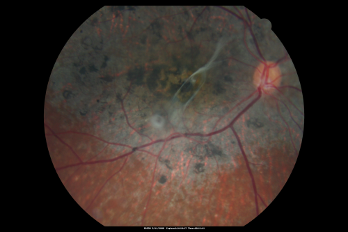 Stargart's Macular Dystrophy Severe - New Vitreomacular Asymptomatic Vitreomacular Traction OD
32-year-old man carries a diagnosis of Stargardtâ€™s disease with poor vision in both eyes since he was 13. He has not noticed any substantial change since he was here 4 years ago.
VISUAL ACUITY: OD 10/200, OS 8/200
Keywords: stargart' stargart