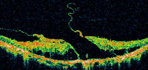 Stargart's Macular Dystrophy Severe - New Vitreomacular Asymptomatic Vitreomacular Traction OD
32-year-old man carries a diagnosis of Stargardtâ€™s disease with poor vision in both eyes since he was 13. He has not noticed any substantial change since he was here 4 years ago.
VISUAL ACUITY: OD 10/200, OS 8/200
Keywords: stargart' stargart