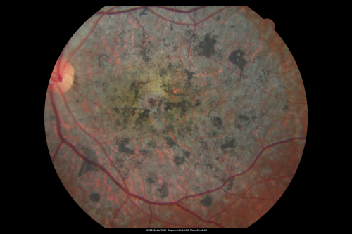 Stargart's Macular Dystrophy Severe
32-year-old man carries a diagnosis of Stargardtâ€™s disease with poor vision in both eyes since he was 13. He has not noticed any substantial change since he was here 4 years ago.
VISUAL ACUITY: OD 10/200, OS 8/200
Mots-clés: stargart' stargart