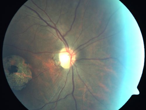 Stargardt's Disease - Macular Dystrophy - 69 Year Old African American Male - 20/200 both eyes
69-year-old man has had vision loss in both eyes starting 20 years ago. He was diagnosed at one point with Stargardtâ€™s macular dystrophy.  When I saw him, he had retinal atrophy in each eye. 
Vision is 20/200 in each eye
