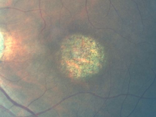 Stargardt's Disease - Macular Dystrophy - 69 Year Old African American Male - 20/200 both eyes
69-year-old man has had vision loss in both eyes starting 20 years ago. He was diagnosed at one point with Stargardtâ€™s macular dystrophy.  When I saw him, he had retinal atrophy in each eye. 
Vision is 20/200 in each eye
