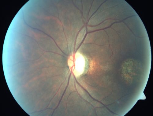 Stargardt's Disease - Macular Dystrophy - 69 Year Old African American Male - 20/200 both eyes
69-year-old man has had vision loss in both eyes starting 20 years ago. He was diagnosed at one point with Stargardtâ€™s macular dystrophy.  When I saw him, he had retinal atrophy in each eye. 
Vision is 20/200 in each eye
