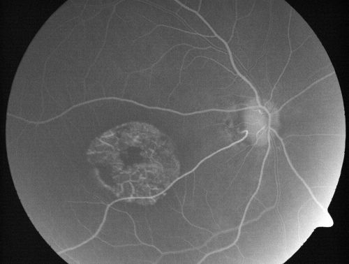 Stargardt's Disease - Macular Dystrophy - 69 Year Old African American Male - 20/200 both eyes
69-year-old man has had vision loss in both eyes starting 20 years ago. He was diagnosed at one point with Stargardtâ€™s macular dystrophy.  When I saw him, he had retinal atrophy in each eye. 
Vision is 20/200 in each eye

