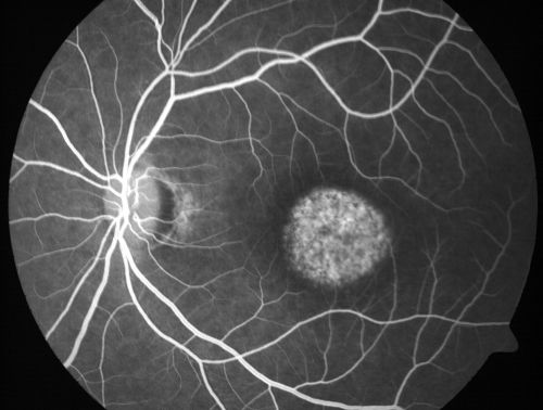 Stargardt's Disease - Macular Dystrophy - 69 Year Old African American Male - 20/200 both eyes
69-year-old man has had vision loss in both eyes starting 20 years ago. He was diagnosed at one point with Stargardtâ€™s macular dystrophy.  When I saw him, he had retinal atrophy in each eye. 
Vision is 20/200 in each eye
