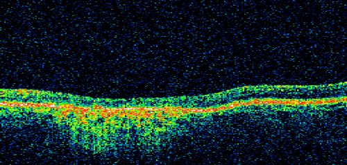 Stargardt's Disease - Macular Dystrophy - 69 Year Old African American Male - 20/200 both eyes
69-year-old man has had vision loss in both eyes starting 20 years ago. He was diagnosed at one point with Stargardtâ€™s macular dystrophy.  When I saw him, he had retinal atrophy in each eye. 
Vision is 20/200 in each eye
