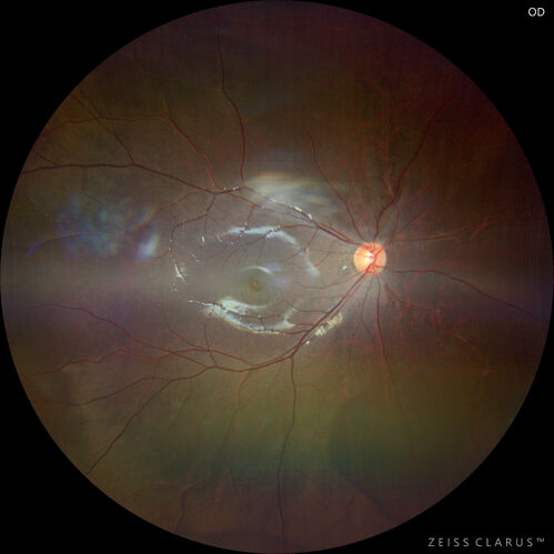 Sticklers syndrome with Pierre Robin Sequence
9 year old child with father who had retinal detachment at age 10.  History of cleft palate repair and teeth removal.  VA 20/40 OU.  Images show perivascular RPE and retinal changes especially nasally
