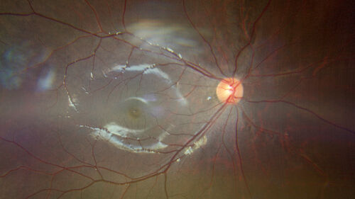 Sticklers syndrome with Pierre Robin Sequence
9 year old child with father who had retinal detachment at age 10.  History of cleft palate repair and teeth removal.  VA 20/40 OU.  Images show perivascular RPE and retinal changes especially nasally
