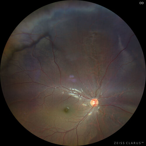 Sticklers syndrome with Pierre Robin Sequence
9 year old child with father who had retinal detachment at age 10.  History of cleft palate repair and teeth removal.  VA 20/40 OU.  Images show perivascular RPE and retinal changes especially nasally
