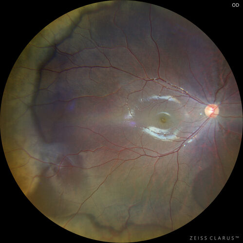 Sticklers syndrome with Pierre Robin Sequence
9 year old child with father who had retinal detachment at age 10.  History of cleft palate repair and teeth removal.  VA 20/40 OU.  Images show perivascular RPE and retinal changes especially nasally
