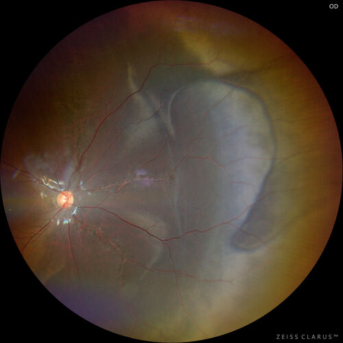 Sticklers syndrome with Pierre Robin Sequence
9 year old child with father who had retinal detachment at age 10.  History of cleft palate repair and teeth removal.  VA 20/40 OU.  Images show perivascular RPE and retinal changes especially nasally
