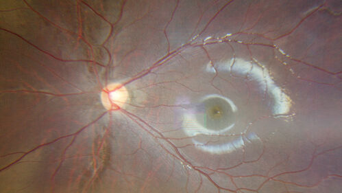 Sticklers syndrome with Pierre Robin Sequence
9 year old child with father who had retinal detachment at age 10.  History of cleft palate repair and teeth removal.  VA 20/40 OU.  Images show perivascular RPE and retinal changes especially nasally
