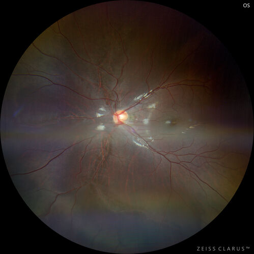 Sticklers syndrome with Pierre Robin Sequence
9 year old child with father who had retinal detachment at age 10.  History of cleft palate repair and teeth removal.  VA 20/40 OU.  Images show perivascular RPE and retinal changes especially nasally

