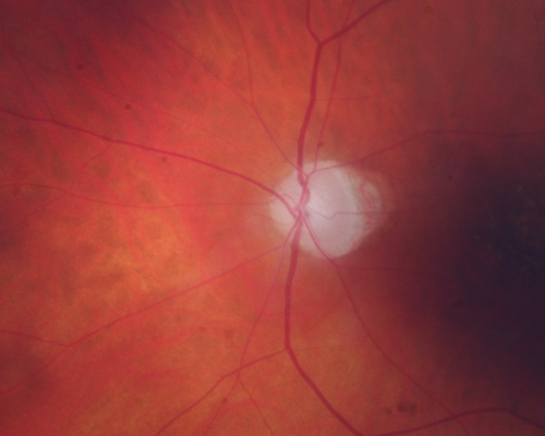Retinal Atrophy 1 year following Streptococcus sanguinis endophthalmitis - Vision 5/200
79 year old woman with sleep apnea who sleeps with CPAP machine
