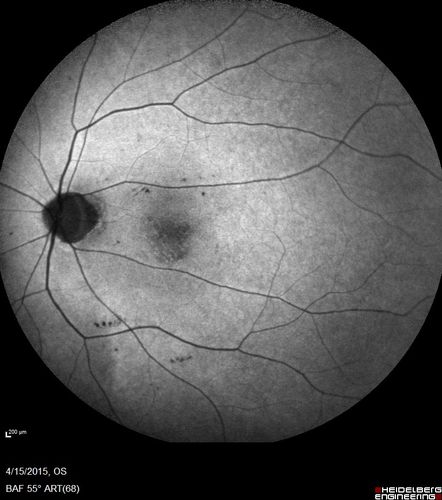 Retinal Atrophy 1 year following Streptococcus sanguinis endophthalmitis - Vision 5/200
79 year old woman with sleep apnea who sleeps with CPAP machine
