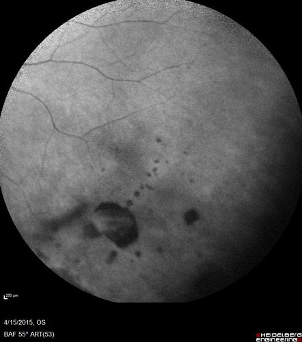 Retinal Atrophy 1 year following Streptococcus sanguinis endophthalmitis - Vision 5/200
79 year old woman with sleep apnea who sleeps with CPAP machine
