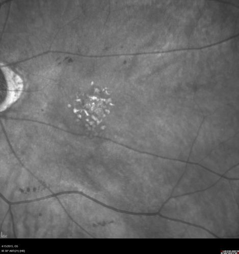 Retinal Atrophy 1 year following Streptococcus sanguinis endophthalmitis - Vision 5/200
79 year old woman with sleep apnea who sleeps with CPAP machine
