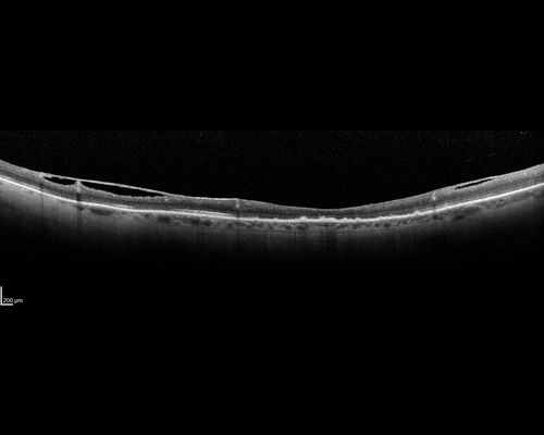 Retinal Atrophy 1 year following Streptococcus sanguinis endophthalmitis - Vision 5/200
79 year old woman with sleep apnea who sleeps with CPAP machine
