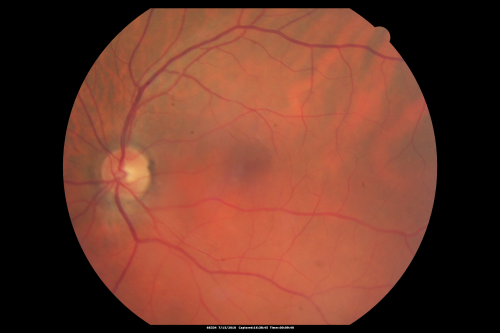 Sturge-Weber Encephalotigeminal Angiomatosis - Facial Hemangioma and Asymptomatic Ipsilateral Diffuse Choroidal Hemangioma
61-year-old man with Sturge-Weber syndrome with a hemangioma on the left side of his face. 

VISUAL ACUITY:  Vision OD is 20/50, PH 20/30; OS 20/80, PH 20/30.  IOP:  OD 16, OS 19.

