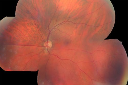 Sturge-Weber Encephalotigeminal Angiomatosis - Facial Hemangioma and Asymptomatic Ipsilateral Diffuse Choroidal Hemangioma
61-year-old man with Sturge-Weber syndrome with a hemangioma on the left side of his face. 

VISUAL ACUITY:  Vision OD is 20/50, PH 20/30; OS 20/80, PH 20/30.  IOP:  OD 16, OS 19.

