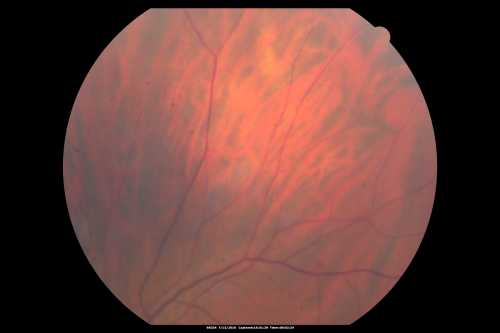 Sturge-Weber Encephalotigeminal Angiomatosis - Facial Hemangioma and Asymptomatic Ipsilateral Diffuse Choroidal Hemangioma
61-year-old man with Sturge-Weber syndrome with a hemangioma on the left side of his face. 

VISUAL ACUITY:  Vision OD is 20/50, PH 20/30; OS 20/80, PH 20/30.  IOP:  OD 16, OS 19.

