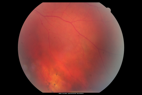 Sturge-Weber Encephalotigeminal Angiomatosis - Facial Hemangioma and Asymptomatic Ipsilateral Diffuse Choroidal Hemangioma
61-year-old man with Sturge-Weber syndrome with a hemangioma on the left side of his face. 

VISUAL ACUITY:  Vision OD is 20/50, PH 20/30; OS 20/80, PH 20/30.  IOP:  OD 16, OS 19.

