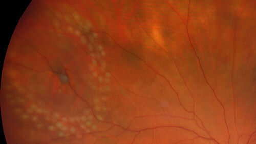 Laser Demarcation small Retinal Detachment
70 year old female with new jelly fish floaters.  VA 20/32 OD, 20/25 OS - Laser was done to superotemporal tear with detachment at 11:00.  Photos show fresh laser
