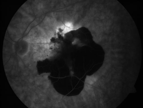 Wet AMD Fresh Submacular Hemorrhage - Displaced with Vitrectomy and Subretinal TPA
85-year-old woman has wet age-related macular degeneration in her better eye and she was reading with it until two days ago when she had sudden severe vision loss in the eye.  Her last injection with Avastin 2 weeks ago   20/160 (Pre-Surgical Displacement)
Keywords: submacular hemorrhage;tpa displacement;wet amd; 