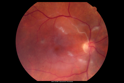 Bilateral Retinal Arteriol Occlusions - Possible Susac Syndrome 
80-year-old woman one month ago had vision loss and a vascular occlusion in the right eye.  Vision loss occurred in the left eye about 9 years ago with cotton wool spots.  Patients has a 30 year history of tinnitis.

Keywords: cotton wool;retinal artery occlusion;retinal arterial occlusion