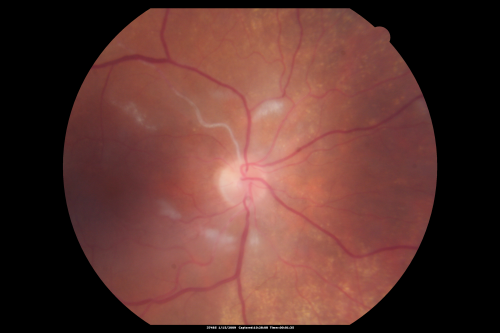 Bilateral Retinal Arteriol Occlusions - Possible Susac Syndrome 
80-year-old woman one month ago had vision loss and a vascular occlusion in the right eye.  Vision loss occurred in the left eye about 9 years ago with cotton wool spots.  Patients has a 30 year history of tinnitis.

Keywords: cotton wool;retinal artery occlusion;retinal arterial occlusion