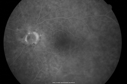Bilateral Retinal Arteriol Occlusions - Possible Susac Syndrome 
80-year-old woman one month ago had vision loss and a vascular occlusion in the right eye.  Vision loss occurred in the left eye about 9 years ago with cotton wool spots.  Patients has a 30 year history of tinnitis.

Keywords: cotton wool;retinal artery occlusion;retinal arterial occlusion