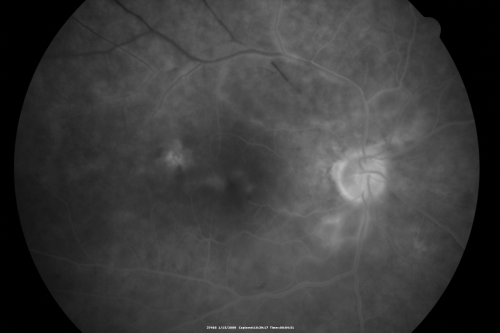 Bilateral Retinal Arteriol Occlusions - Possible Susac Syndrome 
80-year-old woman one month ago had vision loss and a vascular occlusion in the right eye.  Vision loss occurred in the left eye about 9 years ago with cotton wool spots.  Patients has a 30 year history of tinnitis.

Schlüsselwörter: cotton wool;retinal artery occlusion;retinal arterial occlusion