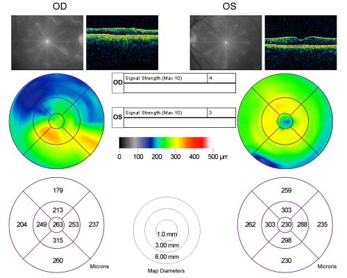 Bilateral Retinal Arteriol Occlusions - Possible Susac Syndrome 
80-year-old woman one month ago had vision loss and a vascular occlusion in the right eye.  Vision loss occurred in the left eye about 9 years ago with cotton wool spots.  Patients has a 30 year history of tinnitis.

Keywords: cotton wool;retinal artery occlusion;retinal arterial occlusion