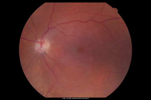 Bilateral Retinal Arteriol Occlusions - Possible Susac Syndrome 
80-year-old woman one month ago had vision loss and a vascular occlusion in the right eye.  Vision loss occurred in the left eye about 9 years ago with cotton wool spots.  Patients has a 30 year history of tinnitis.

Schlüsselwörter: cotton wool;retinal artery occlusion;retinal arterial occlusion