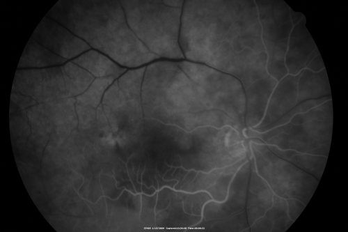 Bilateral Retinal Arteriol Occlusions - Possible Susac Syndrome 
80-year-old woman one month ago had vision loss and a vascular occlusion in the right eye.  Vision loss occurred in the left eye about 9 years ago with cotton wool spots.  Patients has a 30 year history of tinnitis.

Keywords: cotton wool;retinal artery occlusion;retinal arterial occlusion