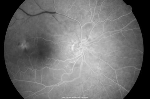 Bilateral Retinal Arteriol Occlusions - Possible Susac Syndrome 
80-year-old woman one month ago had vision loss and a vascular occlusion in the right eye.  Vision loss occurred in the left eye about 9 years ago with cotton wool spots.  Patients has a 30 year history of tinnitis.

Keywords: cotton wool;retinal artery occlusion;retinal arterial occlusion