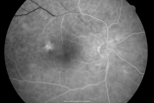 Bilateral Retinal Arteriol Occlusions - Possible Susac Syndrome 
80-year-old woman one month ago had vision loss and a vascular occlusion in the right eye.  Vision loss occurred in the left eye about 9 years ago with cotton wool spots.  Patients has a 30 year history of tinnitis.

Schlüsselwörter: cotton wool;retinal artery occlusion;retinal arterial occlusion