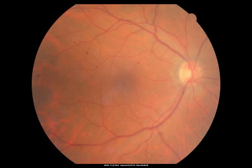 Sturge-Weber Encephalotigeminal Angiomatosis - Facial Hemangioma and Asymptomatic Ipsilateral Diffuse Choroidal Hemangioma
61-year-old man with Sturge-Weber syndrome with a hemangioma on the left side of his face. 

VISUAL ACUITY:  Vision OD is 20/50, PH 20/30; OS 20/80, PH 20/30.  IOP:  OD 16, OS 19.


