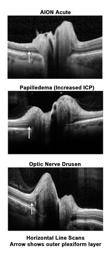 Optic Nerve Swelling - Papilledema - Disc Drusen - AION (this patient is AION)
66 y.o. woman spot in central vision in left eye started about 1 week ago since then it is not changing. VA OD: sc20/25 OS: sc20/200 
