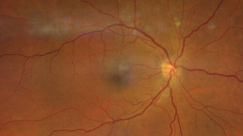 Syphilitic optic neuritis
Two weeks ago she woke up with blurred vision in the left eye.  She usually gets up at 5 AM.  Then she noticed a gray spot in the left eye that did not go away.  This is new for her.  The gray spot is not getting any better or worse in the left eye. (4/4/23)
Systemic Meds: Lisinopril 40 mg. metformin hydrochloride 1000 MG. nifedipine 30mg 
VA OD: sc20/80 PH20/50 NscJ10
VA OS: sc2'/200 Nsc20/400
IOP: TP: OD:15 OS:16 
No AC or vitreous cells - later images was with second eye involved with uveitis.  Patient received IV PCN and was lost to follow-up
