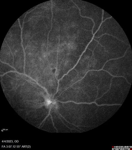 Syphilitic optic neuritis
Two weeks ago she woke up with blurred vision in the left eye.  She usually gets up at 5 AM.  Then she noticed a gray spot in the left eye that did not go away.  This is new for her.  The gray spot is not getting any better or worse in the left eye. (4/4/23)
Systemic Meds: Lisinopril 40 mg. metformin hydrochloride 1000 MG. nifedipine 30mg 
VA OD: sc20/80 PH20/50 NscJ10
VA OS: sc2'/200 Nsc20/400
IOP: TP: OD:15 OS:16 
No AC or vitreous cells - later images was with second eye involved with uveitis.  Patient received IV PCN and was lost to follow-up
