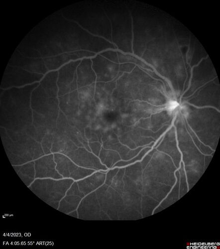 Syphilitic optic neuritis
Two weeks ago she woke up with blurred vision in the left eye.  She usually gets up at 5 AM.  Then she noticed a gray spot in the left eye that did not go away.  This is new for her.  The gray spot is not getting any better or worse in the left eye. (4/4/23)
Systemic Meds: Lisinopril 40 mg. metformin hydrochloride 1000 MG. nifedipine 30mg 
VA OD: sc20/80 PH20/50 NscJ10
VA OS: sc2'/200 Nsc20/400
IOP: TP: OD:15 OS:16 
No AC or vitreous cells - later images was with second eye involved with uveitis.  Patient received IV PCN and was lost to follow-up
